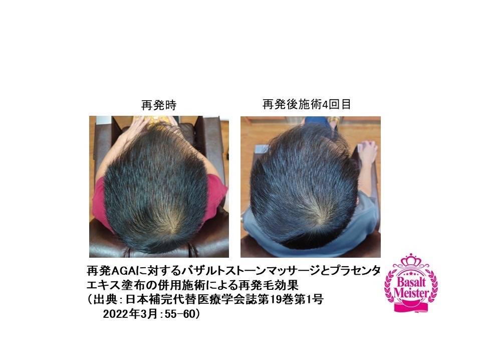 発毛エビデンス